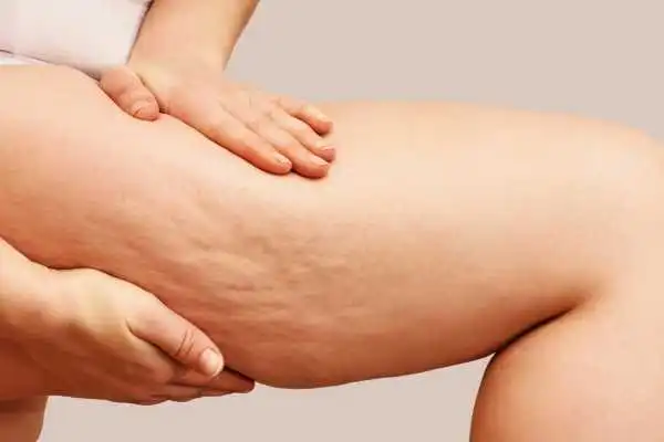 Image of woman showing leg with cellulite Merry Hill