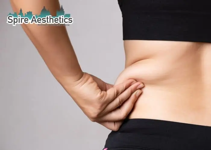 Image of woman pinching fat on their hips Merry Hill. Fat Freezing treatment