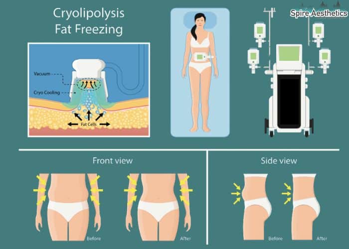 Image of diet and fat freezing combined for best results for Spire Aesthetics Merry Hill
