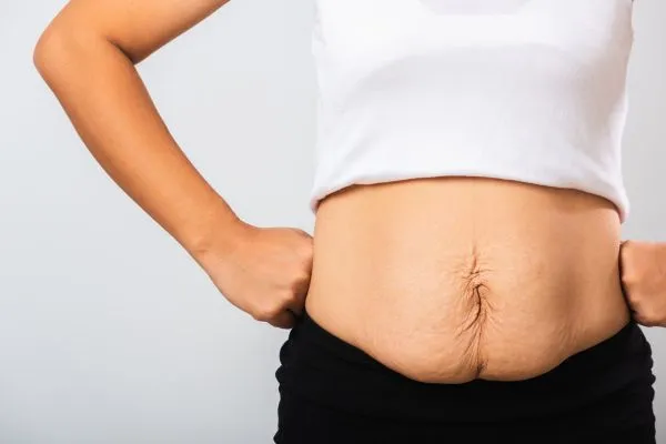 Image of a woman's stomach after weight loss with sagging skin following a gastric band Merry Hill
