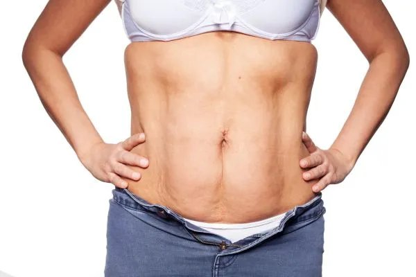 sagging skin on woman's stomach after weight loss injections Merry Hill