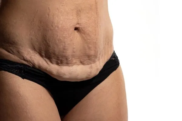Image of womans stomach after weight loss injections Merry Hill showing saggy skin