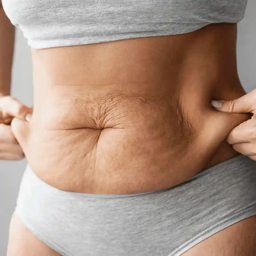Is It Normal to Have Loose Skin After Pregnancy Merry Hill?